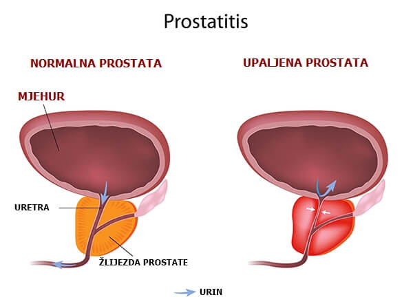 Prostata kod muskaraca