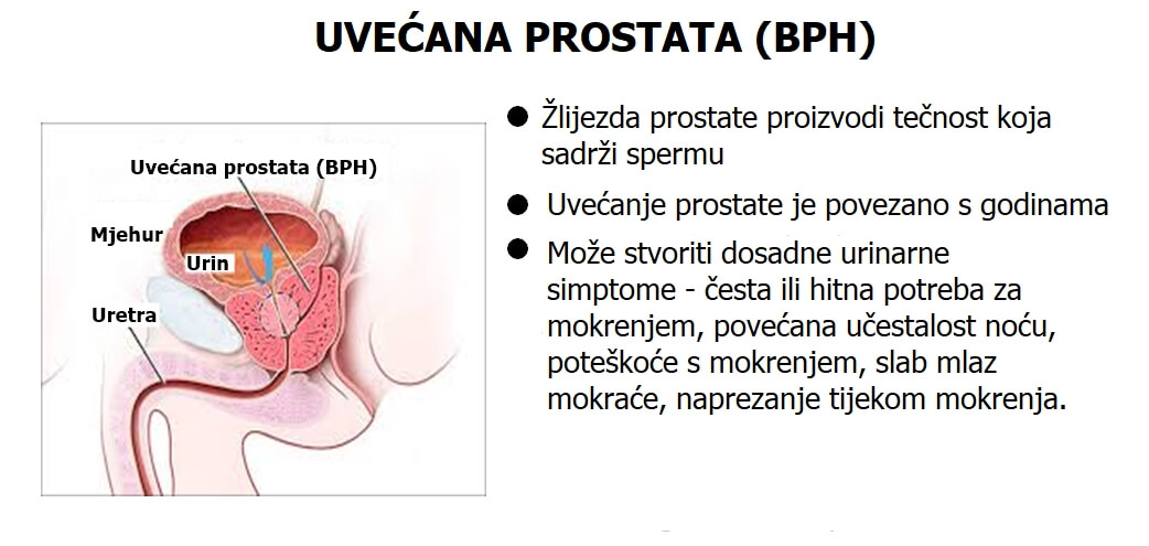 Prostata kod muskaraca